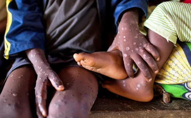 WHO Declares Mpox Outbreak in Africa a Global Health Emergency